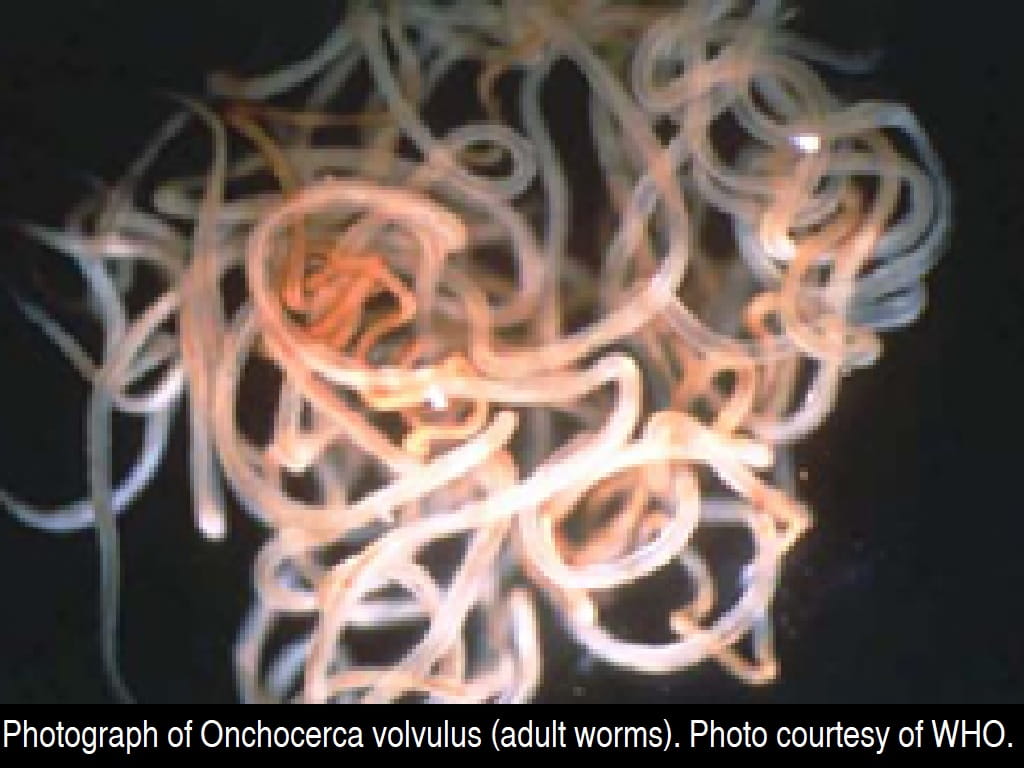 Photograph of Onchocerca volvulus (adult worms). Photo courtesy of WHO.