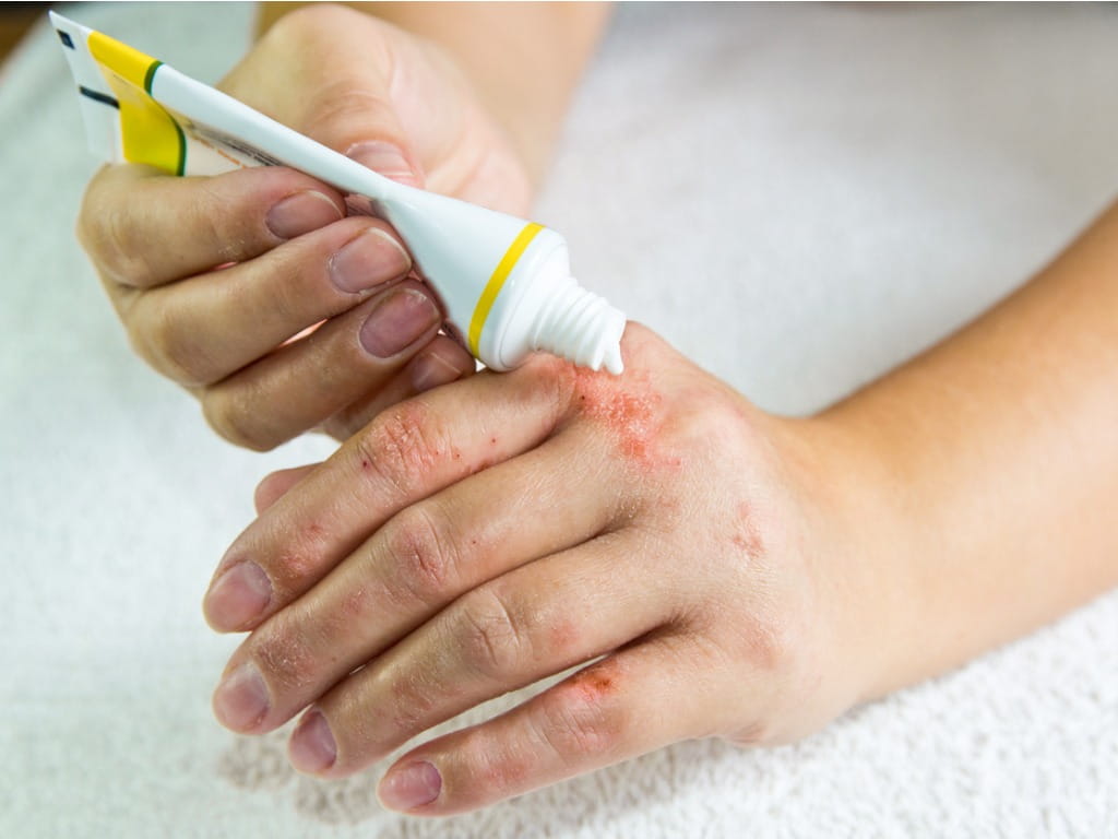 applying hydrocortisone on hand for eczema