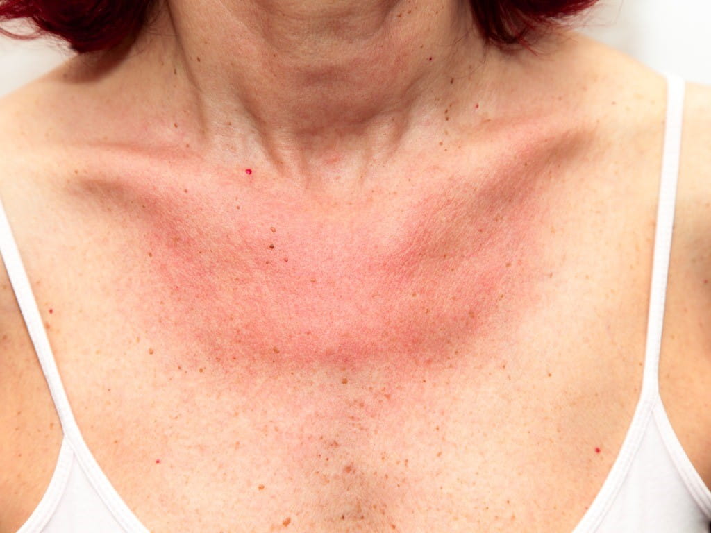 photoallergic dermatitis woman with red rash on chest