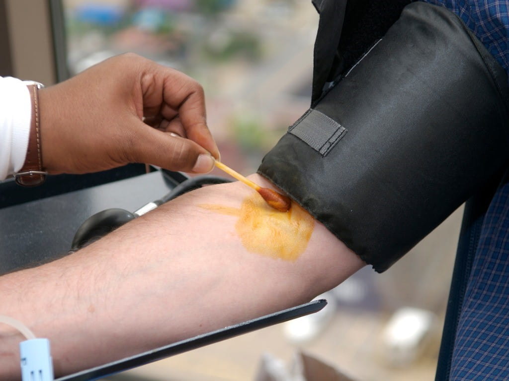 povidone iodine antiseptic to disinfect blood donors arm