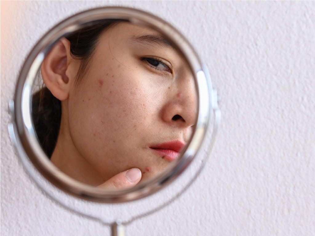 woman looking at her acne in the mirror